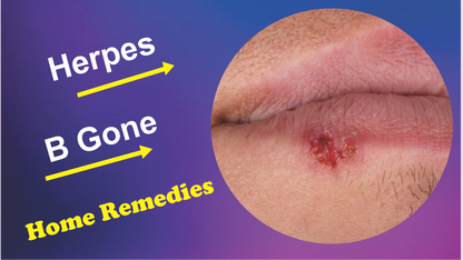 Herpes B Gone: Cream for herpes sores