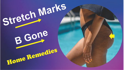 Stretch marks natural solution